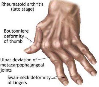 Rheumatoid - Arthritis Care
