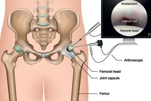 what is hip arthroscopy 183921605244095 1 - Services